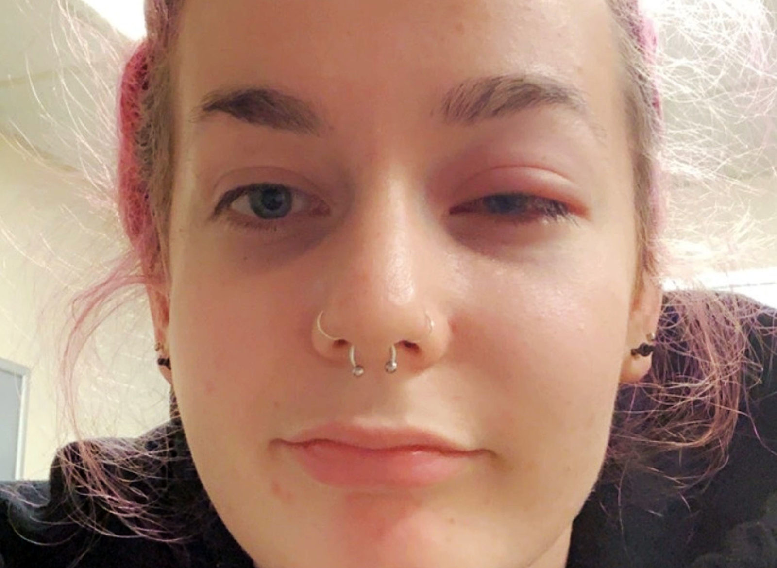 Студентка получила химический ожог глаз мицеллярной водой